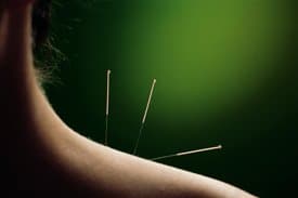 Acupuncture and Dry Needling