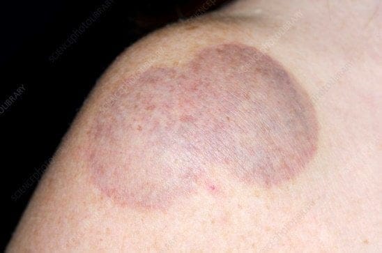cupping therapy bruises