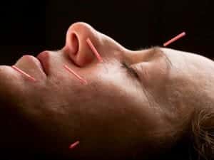 Acupuncture and Dry Needling