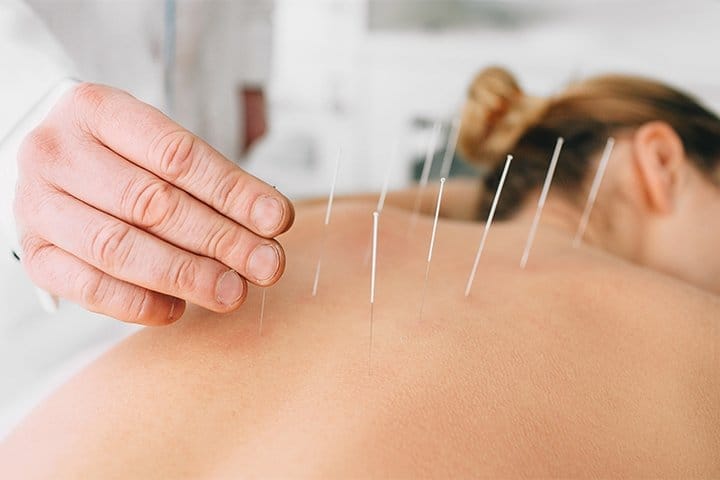 Technique Of Dry Needling