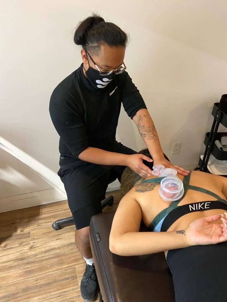 cupping therapy