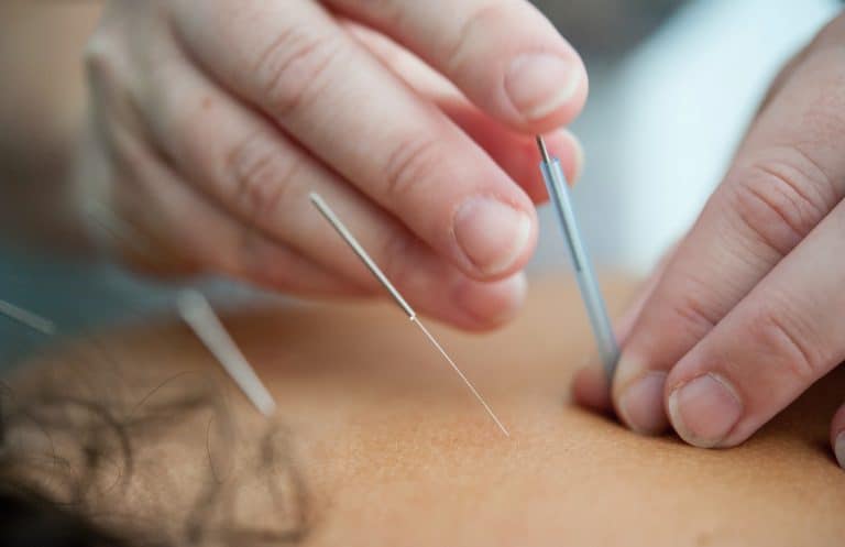 Acupuncture and Dry Needling