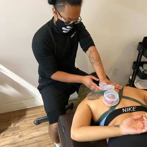cupping therapy
