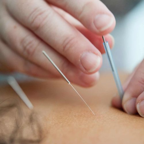 Acupuncture and Dry Needling